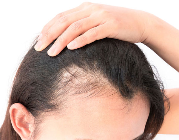Moderate-stage-hair-loss